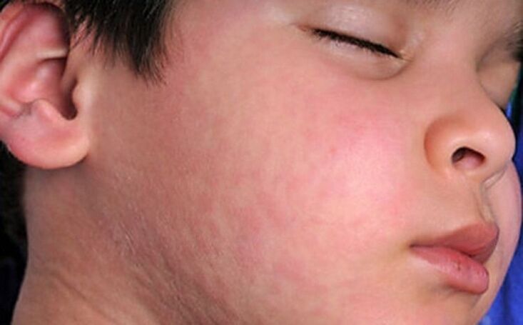 Erupcións alérxicas na pel - un síntoma da presenza de vermes parasitarios no corpo